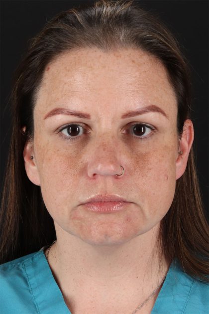 Chemical Peels Before & After Patient #11070