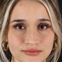Rhinoplasty Before & After Patient #12260