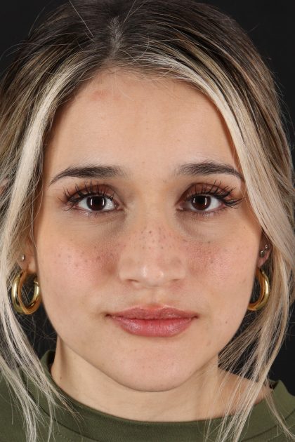 Rhinoplasty Before & After Patient #12260
