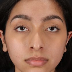 Chin Implant Before & After Patient #13706
