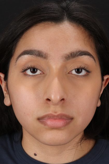 Chin Implant Before & After Patient #13706