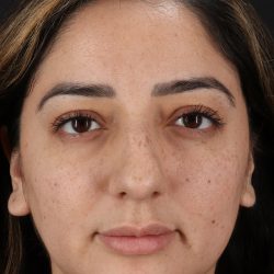 Rhinoplasty Before & After Patient #12392