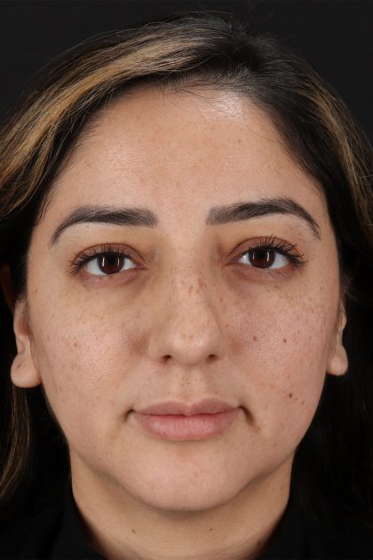 Rhinoplasty Before & After Patient #12392