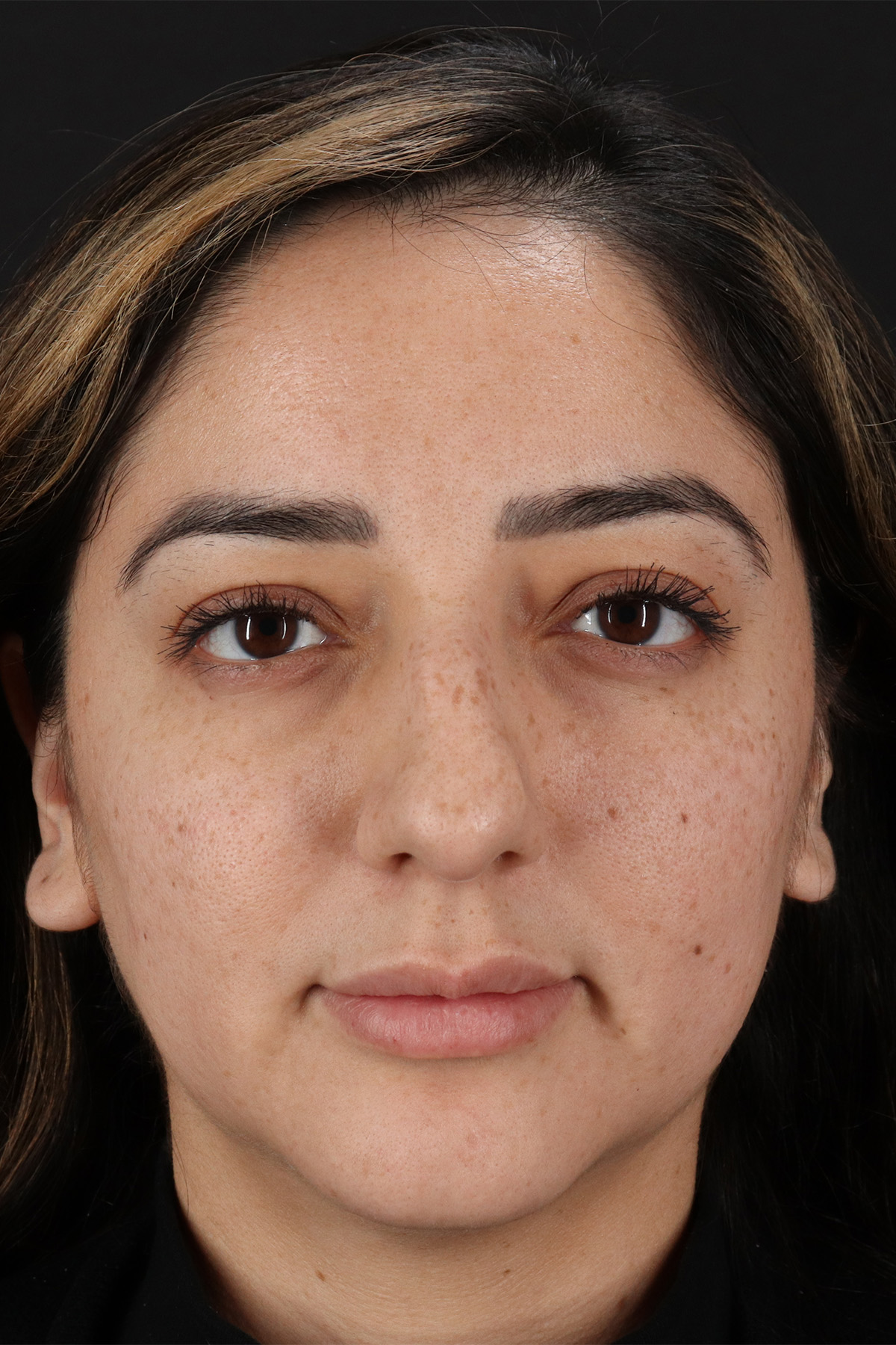 Rhinoplasty Before & After Patient #12392