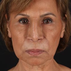 Facelift Before & After Patient #11697