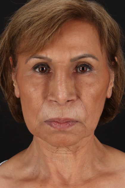 Facelift Before & After Patient #11697