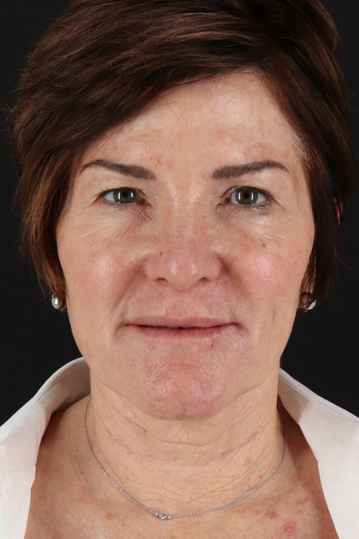 Facelift Before & After Patient #10815