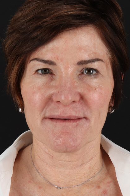 CO2 Laser Before & After Patient #11872