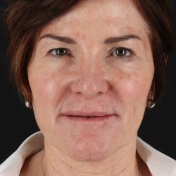 Neck Lift Before & After Patient #10804