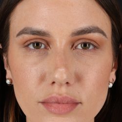 Rhinoplasty Before & After Patient #12370