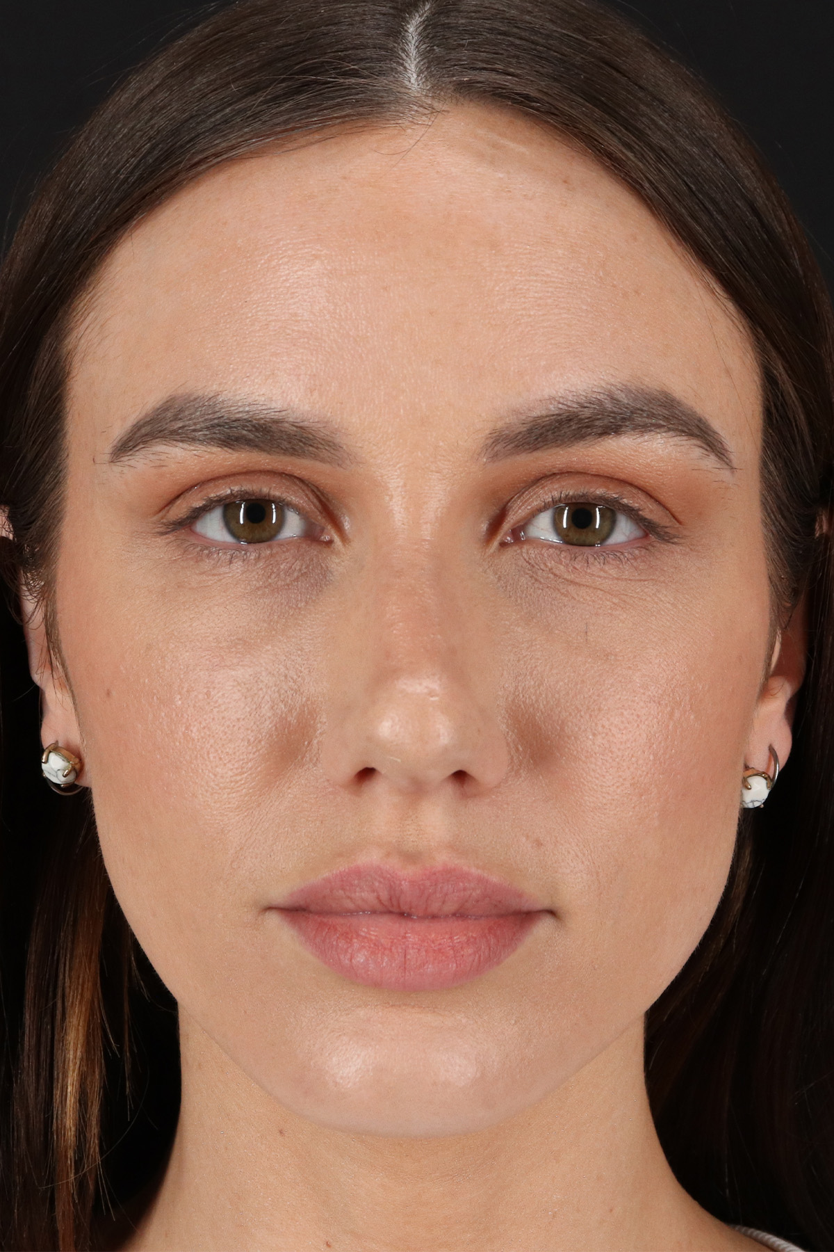Rhinoplasty Before & After Patient #12370