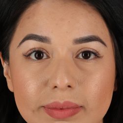 Chin Implant Before & After Patient #13717
