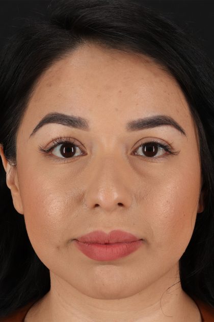Chin Implant Before & After Patient #13717