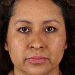 Rhinoplasty Before & After Patient #12293