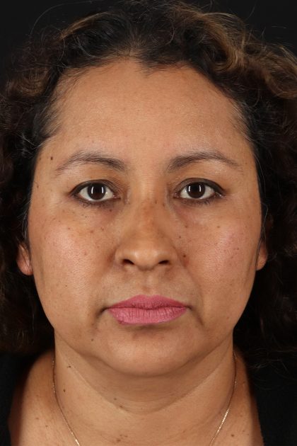 Rhinoplasty Before & After Patient #12293