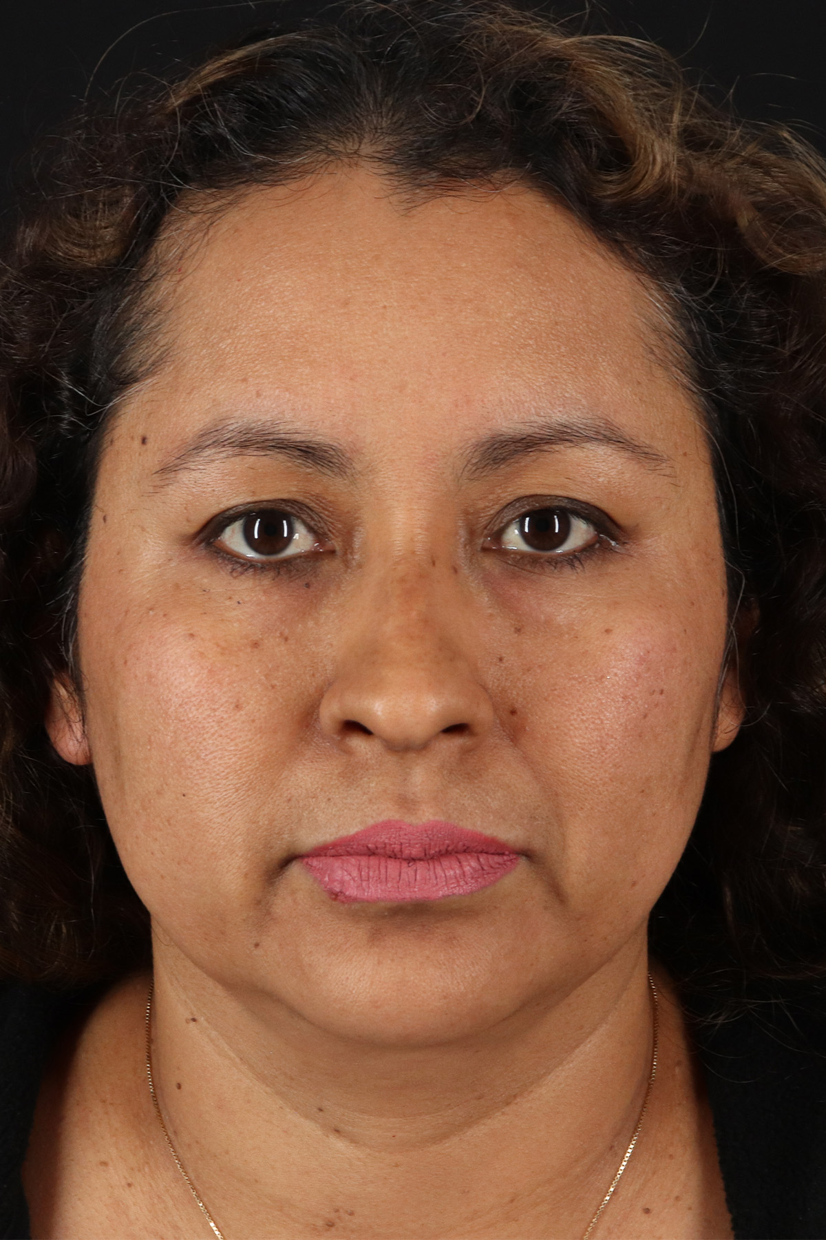 Rhinoplasty Before & After Patient #12293
