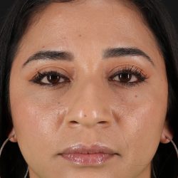 Rhinoplasty Before & After Patient #12425