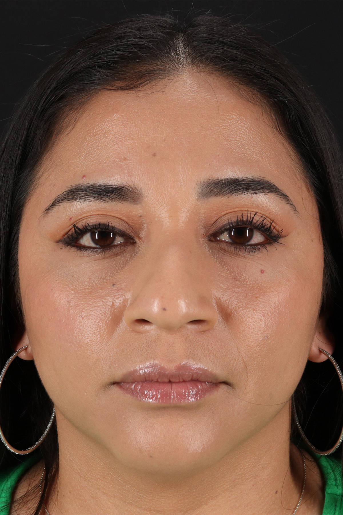 Rhinoplasty Before & After Patient #12425