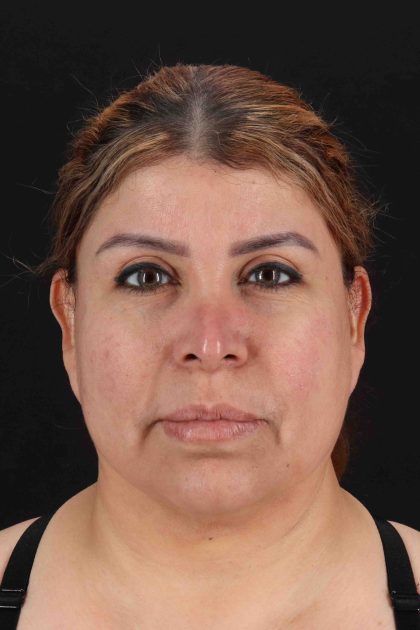 Fat Grafting To The Face Before & After Patient #11850