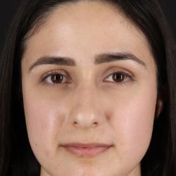 Liquid Rhinoplasty Before & After Patient #11339