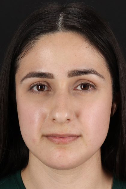 Liquid Rhinoplasty Before & After Patient #11339