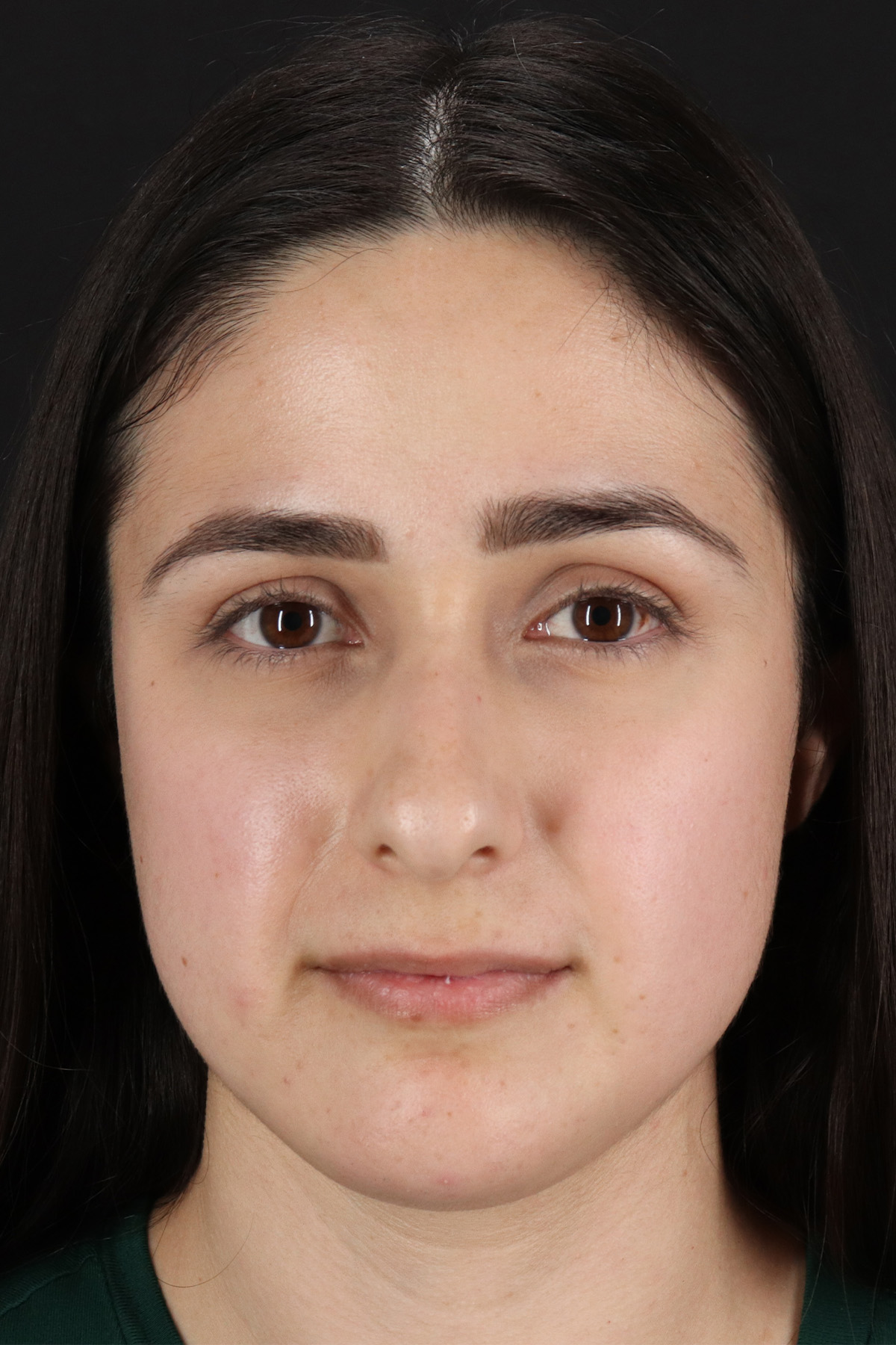 Liquid Rhinoplasty Before & After Patient #11339