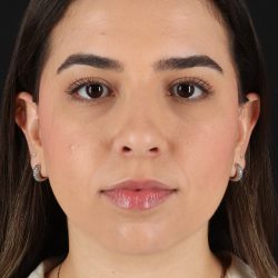 Chin Implant Before & After Patient #11694