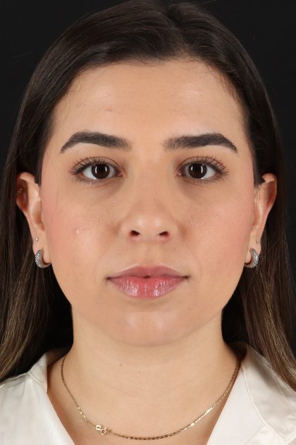 Chin Implant Before & After Patient #11694