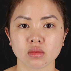 Chin Implant Before & After Patient #13816