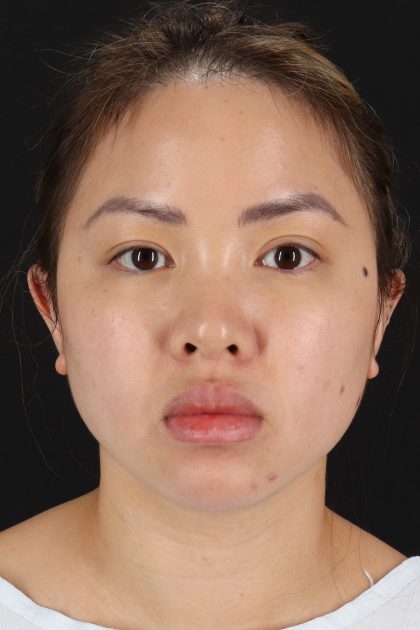 Chin Implant Before & After Patient #13816