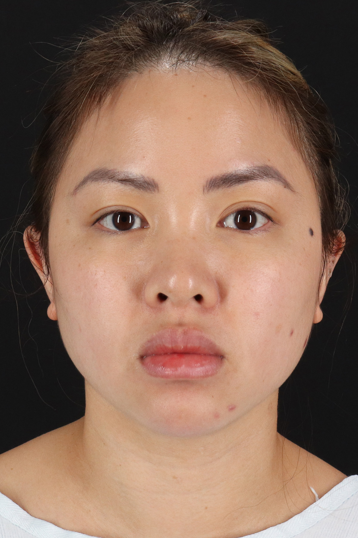 Chin Implant Before & After Patient #13816