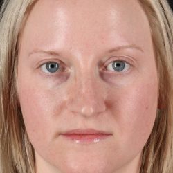 Rhinoplasty Before & After Patient #12381
