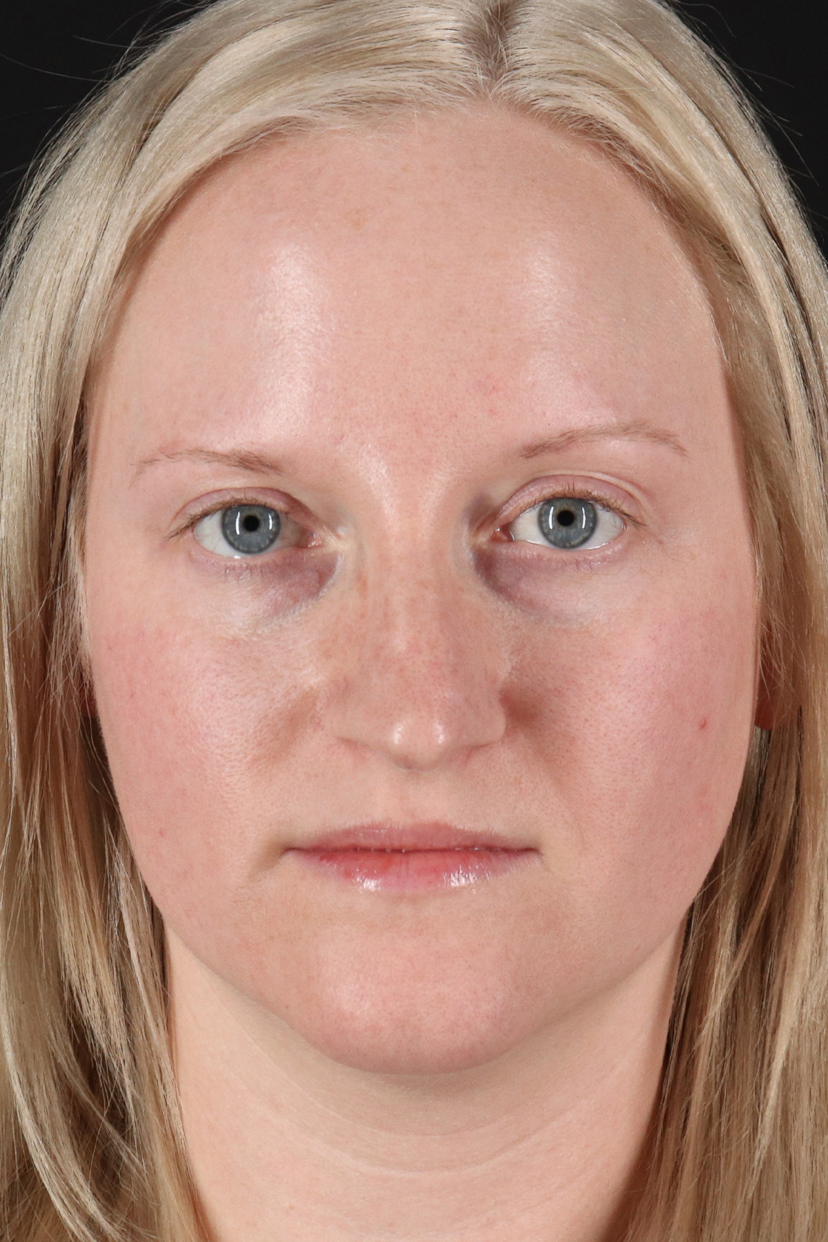 Rhinoplasty Before & After Patient #12381
