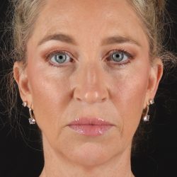 Chin Implant Before & After Patient #13827