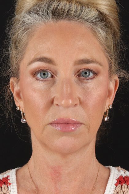 Upper Blepharoplasty Before & After Patient #12084