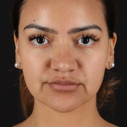 Rhinoplasty Before & After Patient #12326