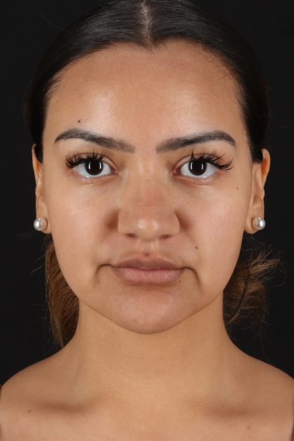 Rhinoplasty Before & After Patient #12326