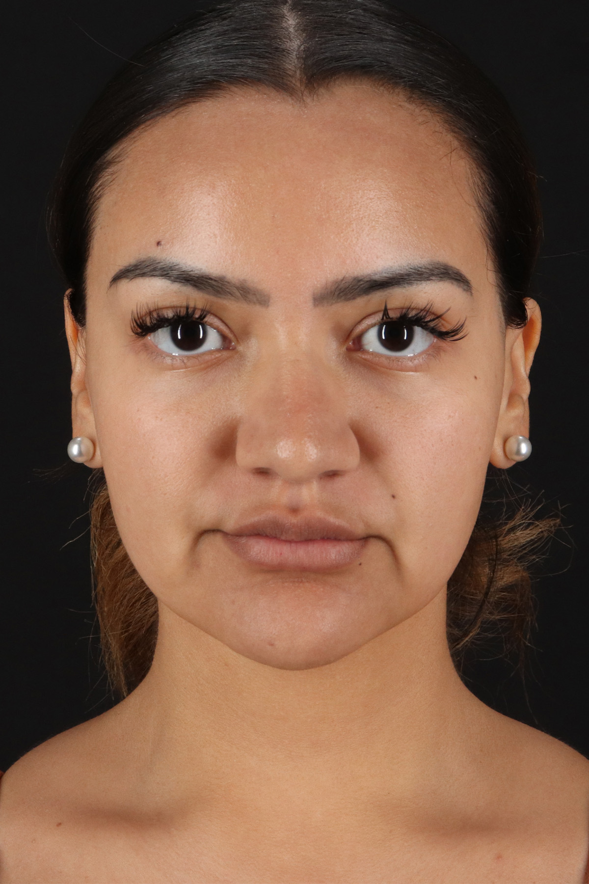 Rhinoplasty Before & After Patient #12326