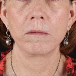 Neck Liposuction Before & After Patient #12117