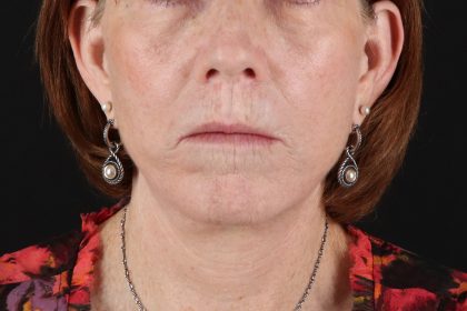 Neck Liposuction Before & After Patient #12117