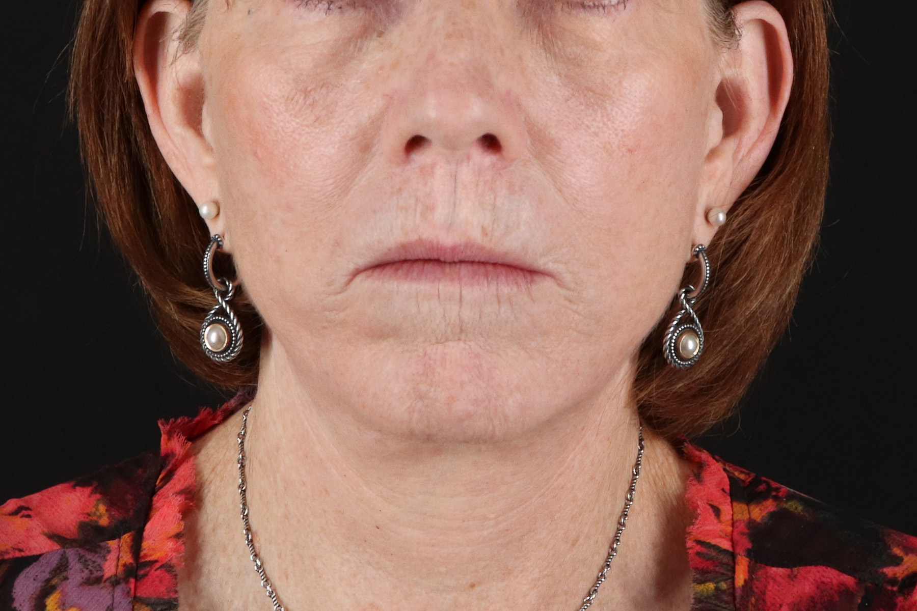 Neck Liposuction Before & After Patient #12117