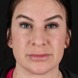Rhinoplasty Before & After Patient #12414