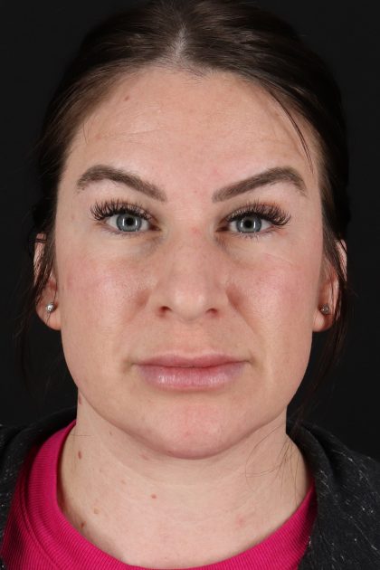 Rhinoplasty Before & After Patient #12414