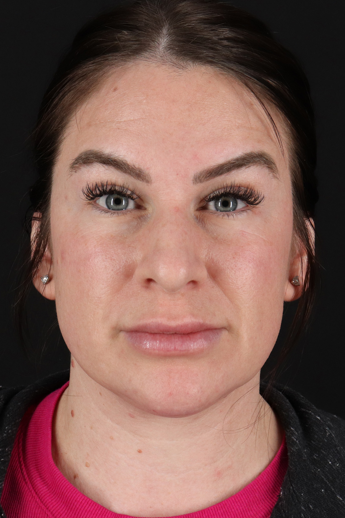 Rhinoplasty Before & After Patient #12414