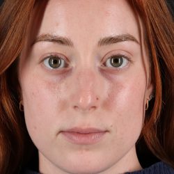 Rhinoplasty Before & After Patient #12348