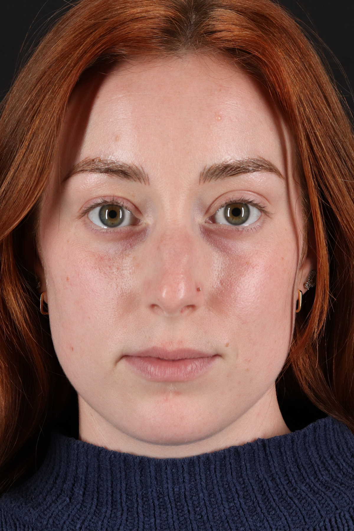 Rhinoplasty Before & After Patient #12348