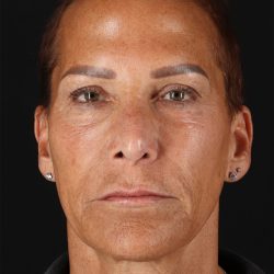 CO2 Laser Before & After Patient #10980