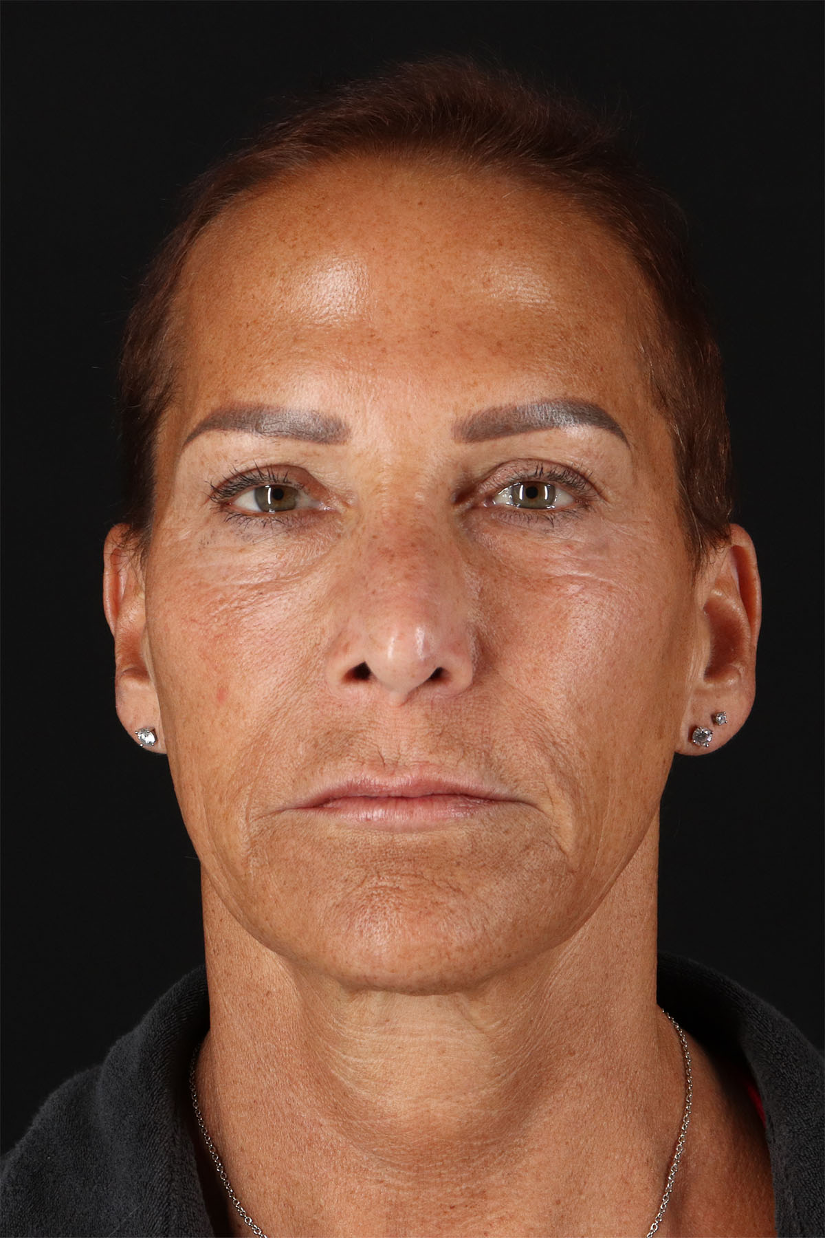 CO2 Laser Before & After Patient #10980