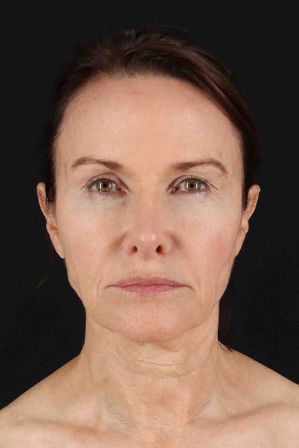 Fat Grafting To The Face Before & After Patient #11839