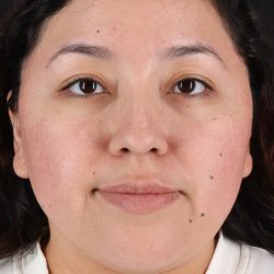 Rhinoplasty Before & After Patient #12447